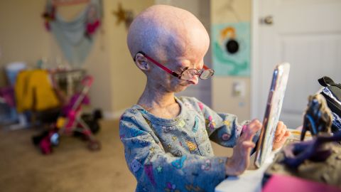 Een 11-jarige Adalia speelt in 2017 met haar telefoon in haar kamer. Naast vroegtijdige veroudering zijn andere symptomen van progeria dwerggroei, gebrek aan lichaamsvet en spiermassa, haarverlies, zichtbare aderen, een hoge stem, en stijfheid in gewrichten. 