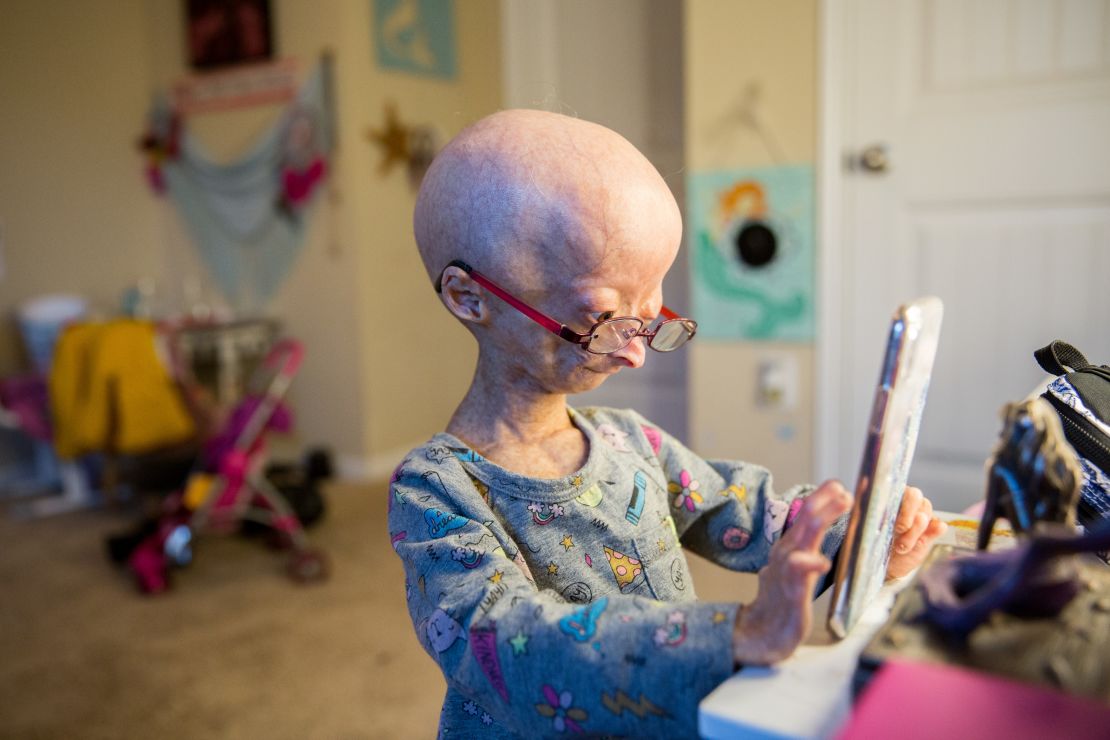 An 11-year-old Adalia plays with her phone in her room in 2017. In additional to premature aging, other symptoms of progeria include dwarfism, lack of body fat and muscle, loss of hair, visible veins, a high-pitched voice, and stiffness in joints. 
