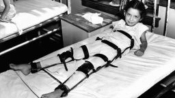 A young polio victim in bed with a body and leg brace in Sept.1937. 
