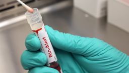 A swab that tested positive for the Monkeypox virus is seen at the UW Medicine Virology Laboratory at the UW Medicine Virology Laboratory on July 12, 2022 in Seattle, Washington. 
