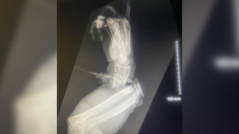 X-ray image shows the damage to Graziani's arm