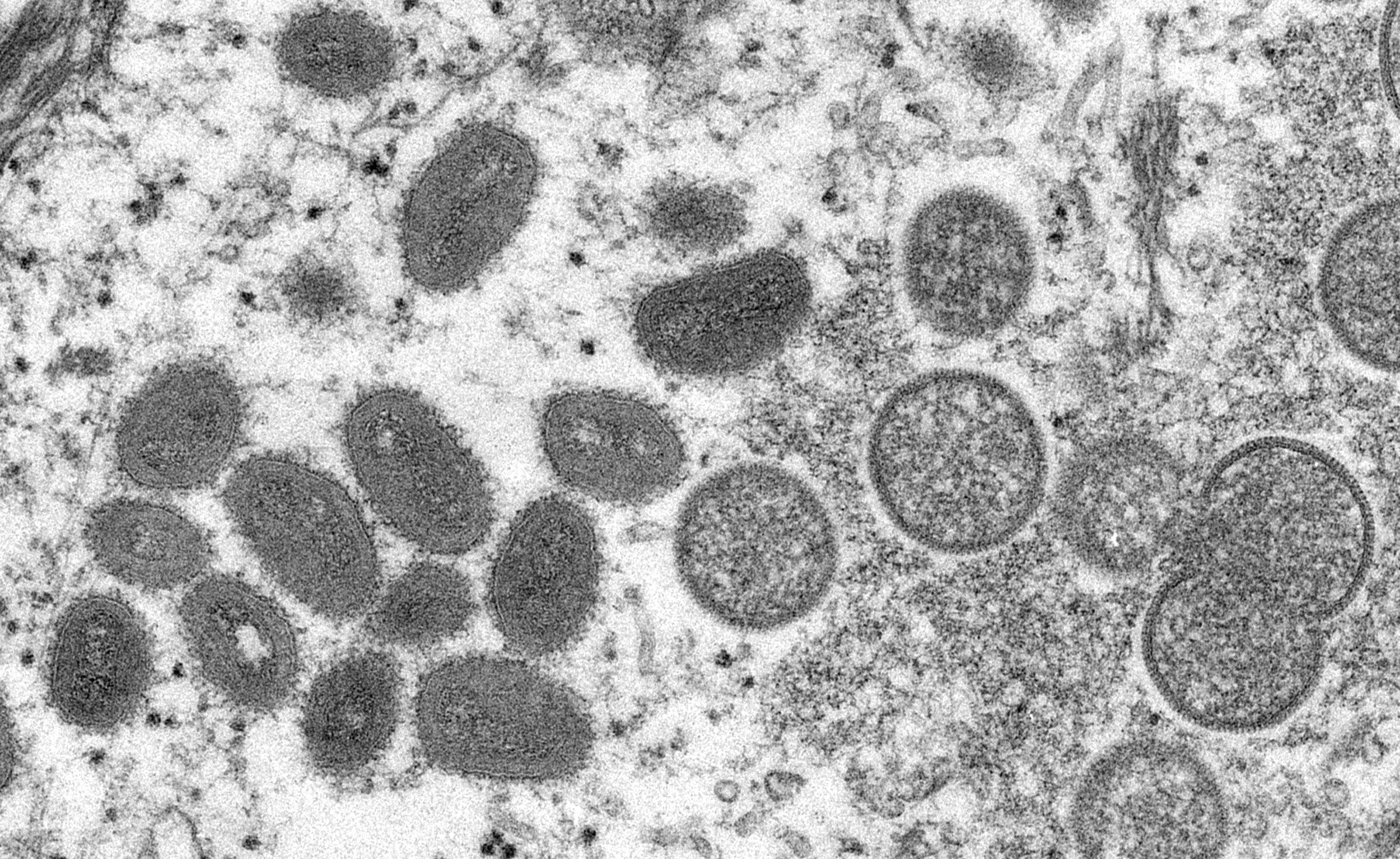 Study describes monkeypox in women; CDC warns of Tpoxx resistance