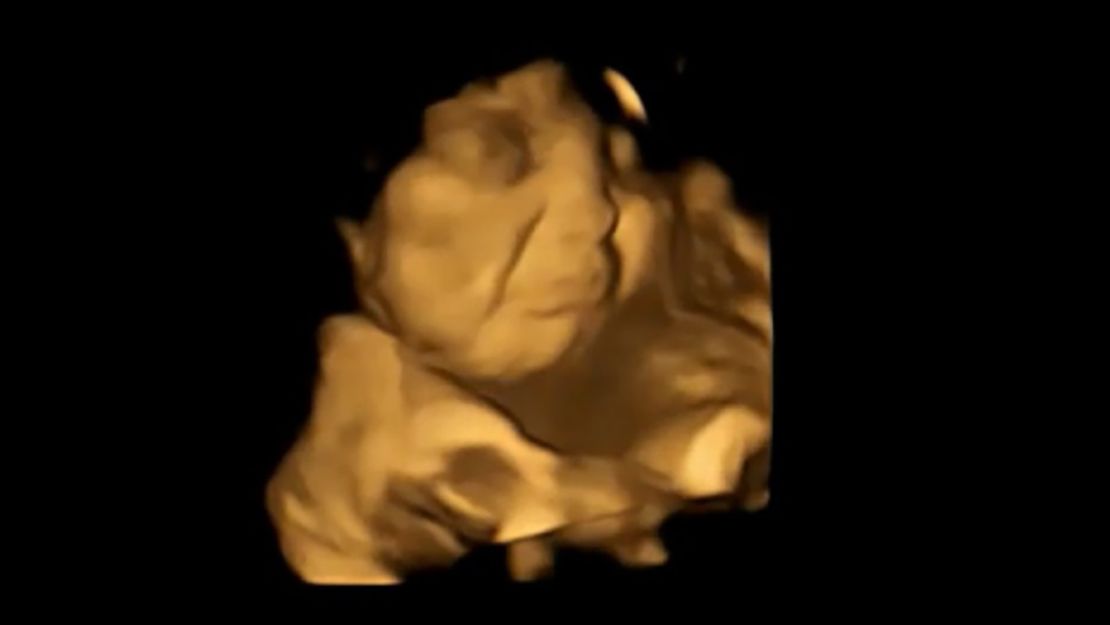 A 4D scan image of the same fetus showing a cry-face reaction after being exposed to the kale flavor.