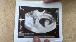 The woman asked for the ultrasound picture so she could see what could have been her child. 