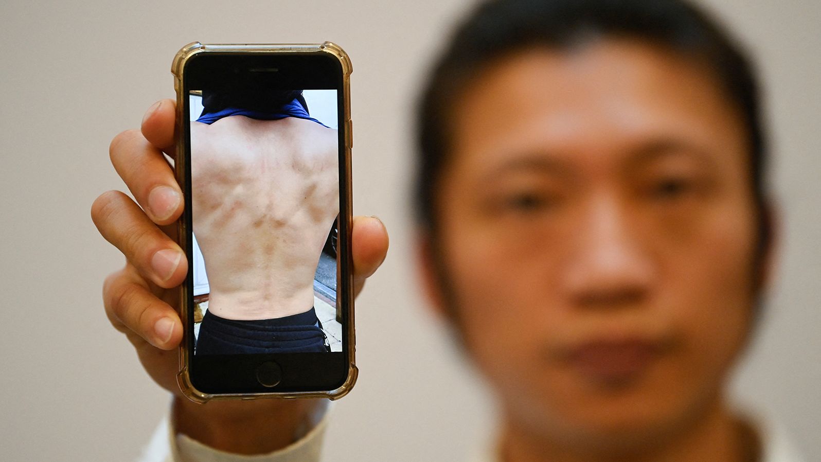 Hong Kong protester Bob Chan shows a photograph of his injuries at a news conference in London on October 19.