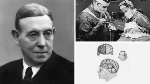 Left: Portuguese neurologist Antonio Egas Moniz was awarded the Nobel Prize in 1949 for pioneering the prefrontal lobotomy.
Upper right: Lobotomies became a popular treatment option from the 1930s to the early 1950s. Here, a surgeon drills into a patient's skull at a hospital in England, 1946.
Lower right: By cutting tracts through brain matter in the frontal lobe, the belief was the lobotomy could treat symptoms of mental illness.