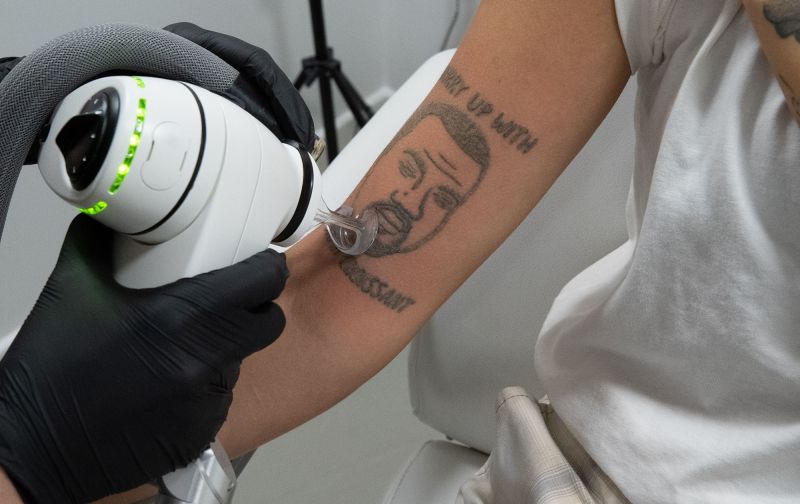 Kanye West former fans have tattoos removed