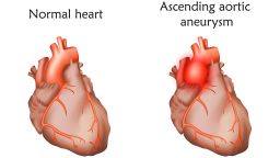 Ascending aortic aneurysm, illustration. Comparison between a damaged and normal heart.