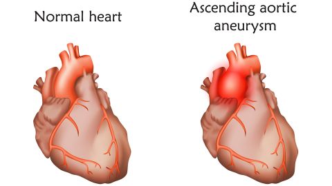 An aortic aneurysm is a bulge in the aorta, the large artery that carries blood from the heart through the chest and torso, according to the US Centers for Disease Control and Prevention.