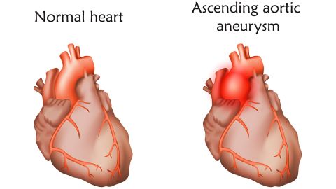 An aortic aneurysm is a bulge in the aorta, the large artery that carries blood from the heart through the chest and torso, according to the US Centers for Disease Control and Prevention.  