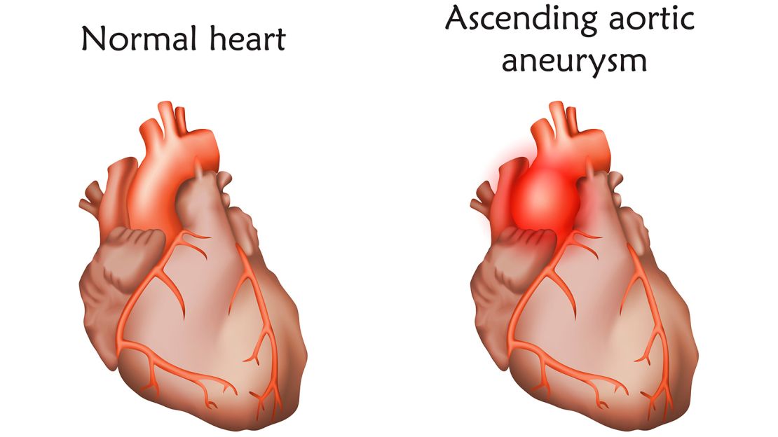 An aortic aneurysm is a bulge in the aorta, the large artery that carries blood from the heart through the chest and torso, according to the US Centers for Disease Control and Prevention.

