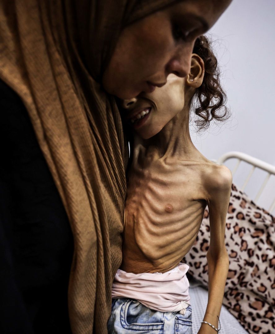 Maryam Duvvas, 9, receives treatment at Patient Friends Association Hospital in Gaza City on Sunday, August 3. She is reported to be in critical condition due to severe malnutrition.