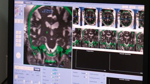 चित्र हरिक के मस्तिष्क के स्कैन हैं।  फोकस्ड अल्ट्रासाउंड ने 80 साल पुराने झटके में काफी सुधार किया।