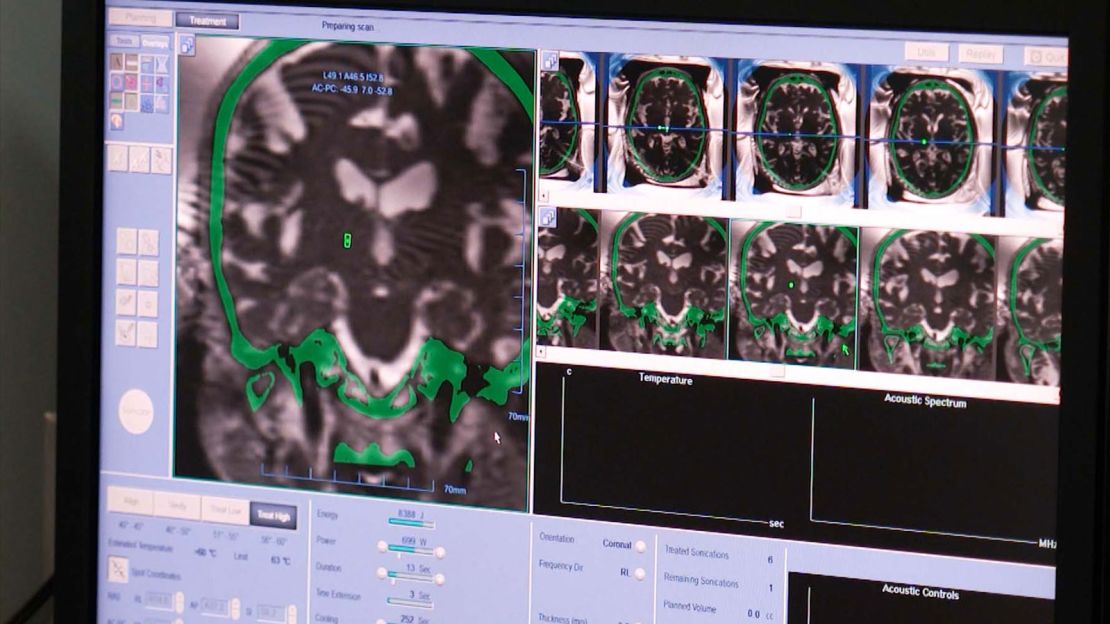 Pictured are scans of Hric's brain. Focused ultrasound signficantly improved the 80-year-old's tremors.
