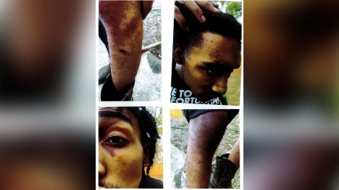 According to the complaint, these photos show some of Harris' injuries approximately 9 days after he was discharged from the hospital.
