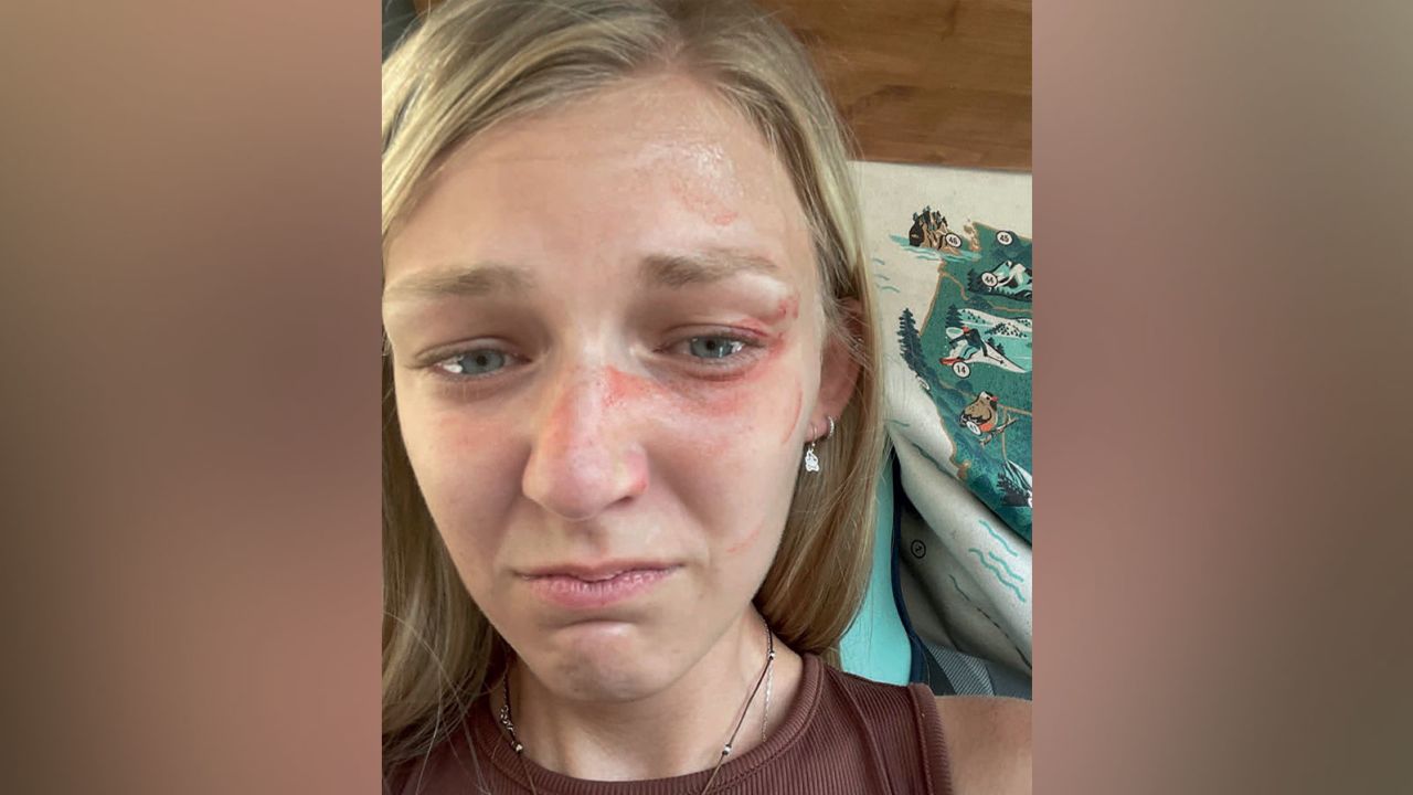 This photo of Gabby Petito showing facial injuries was released by the law office representing her family in a suit against the Moab City Police Department.