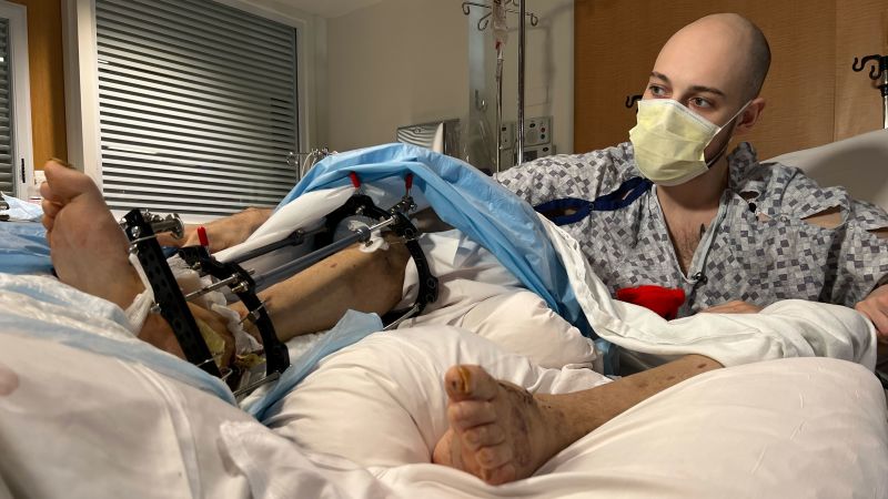 NextImg:A Ukrainian soldier was told his legs could be amputated. An American hospital might help him walk again | CNN
