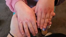 Rashes on 4-year-old East Palestine resident.