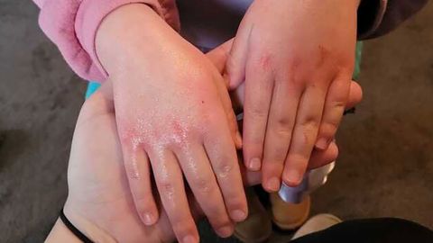 Ayla Antoniazzi's 4-year-old daughter developed a rash after going back to school in East Palestine.