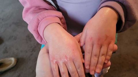 4-year-old daughter Ayla Antoniazzi developed a rash after returning to school in East Palestine.