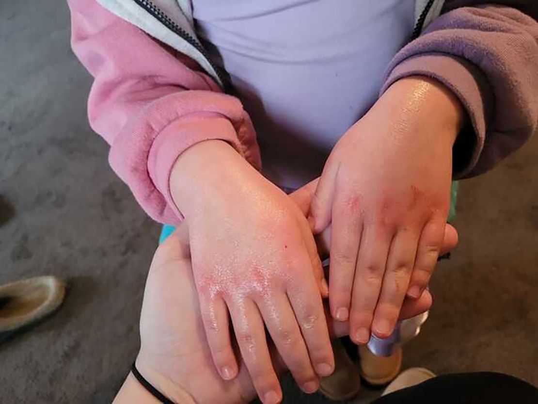 Ayla Antoniazzi's 4-year-old daughter developed a rash after going back to school in East Palestine.