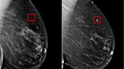 ai tech MIT breast cancer detection split