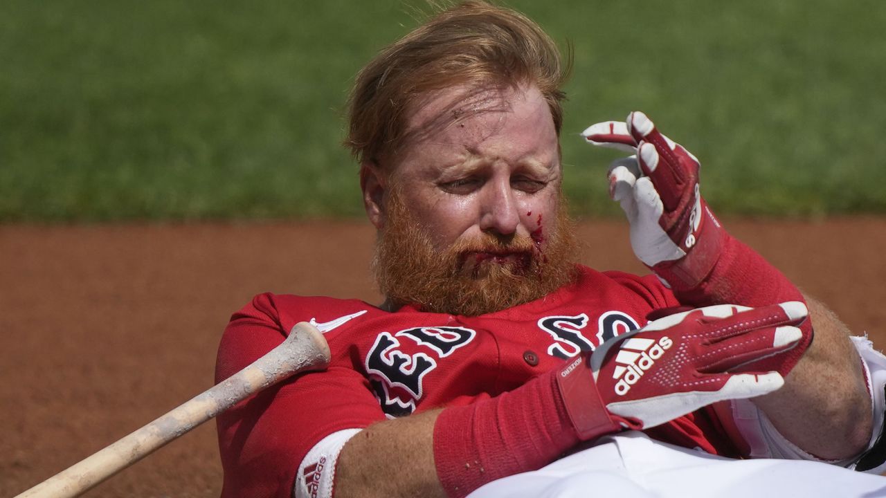 Justin Turner: Boston Red Sox third baseman receives 16 stitches after  taking pitch to the face
