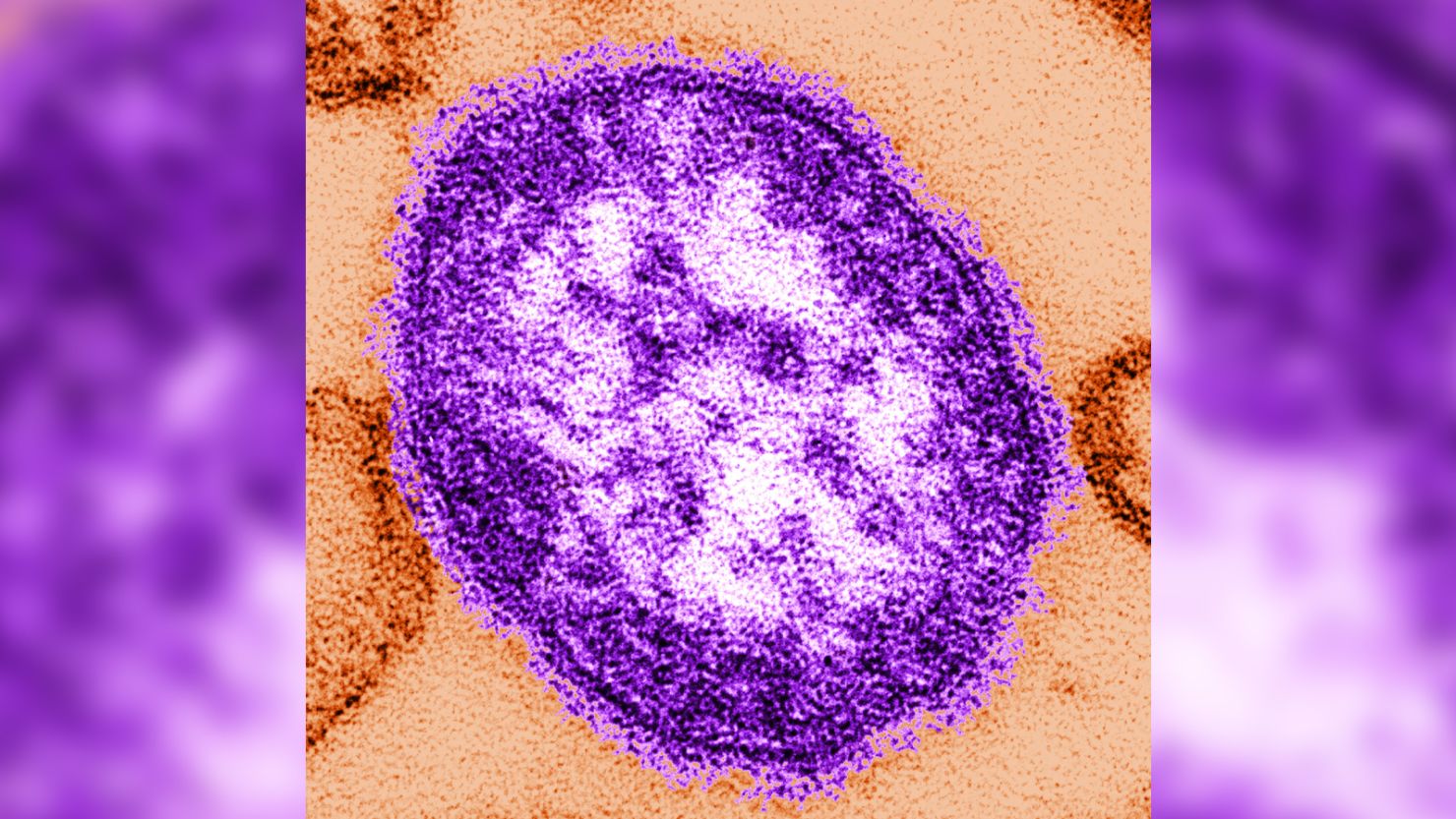 Digitally-colorized, thin-section transmission electron microscopic image of a single measles virus particle, with the viral nucleocapsid situated underneath the viral envelope, surrounded by surface projections.
