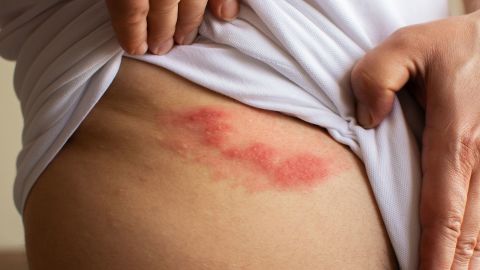 Shingles, also called herpes zoster,  is a painful viral inflammation that can cause a blistering skin rash.
