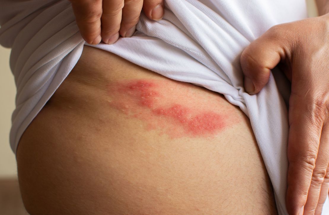 What is the painful condition called shingles?