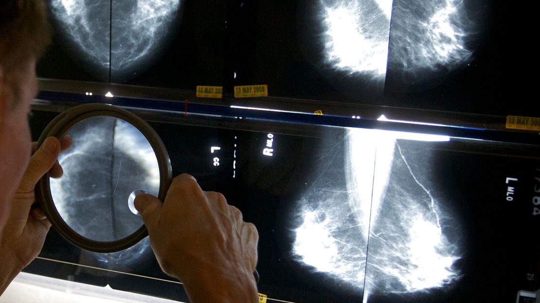 In this file photo, a radiologist uses a magnifying glass to check mammograms for breast cancer in Los Angeles, May 6, 2010. U.S. women getting mammograms will soon receive information about their breast density, which can sometimes make cancer harder to spot, under government rules finalized Thursday, March 9, 2023.