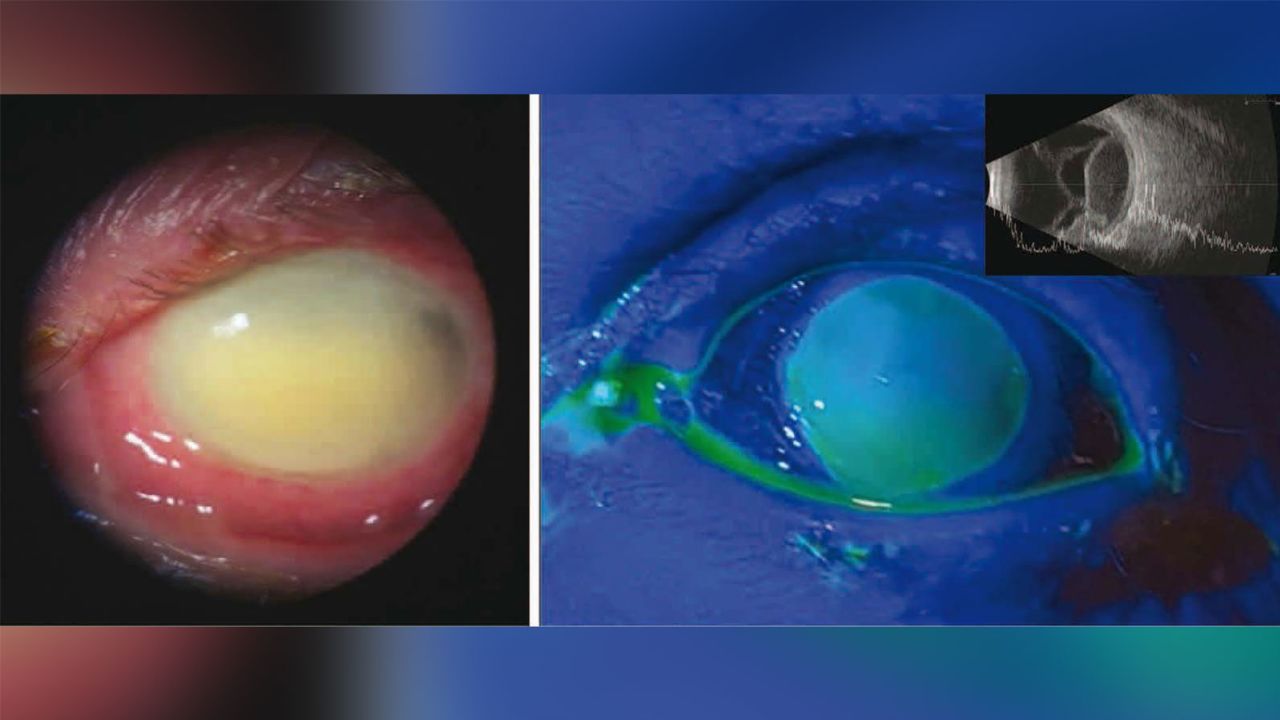 A 72-year-old woman lost vision in her left eye after using EzriCare artificial tears. Details of her case were published Wednesday in the journal JAMA Ophthalmology. 