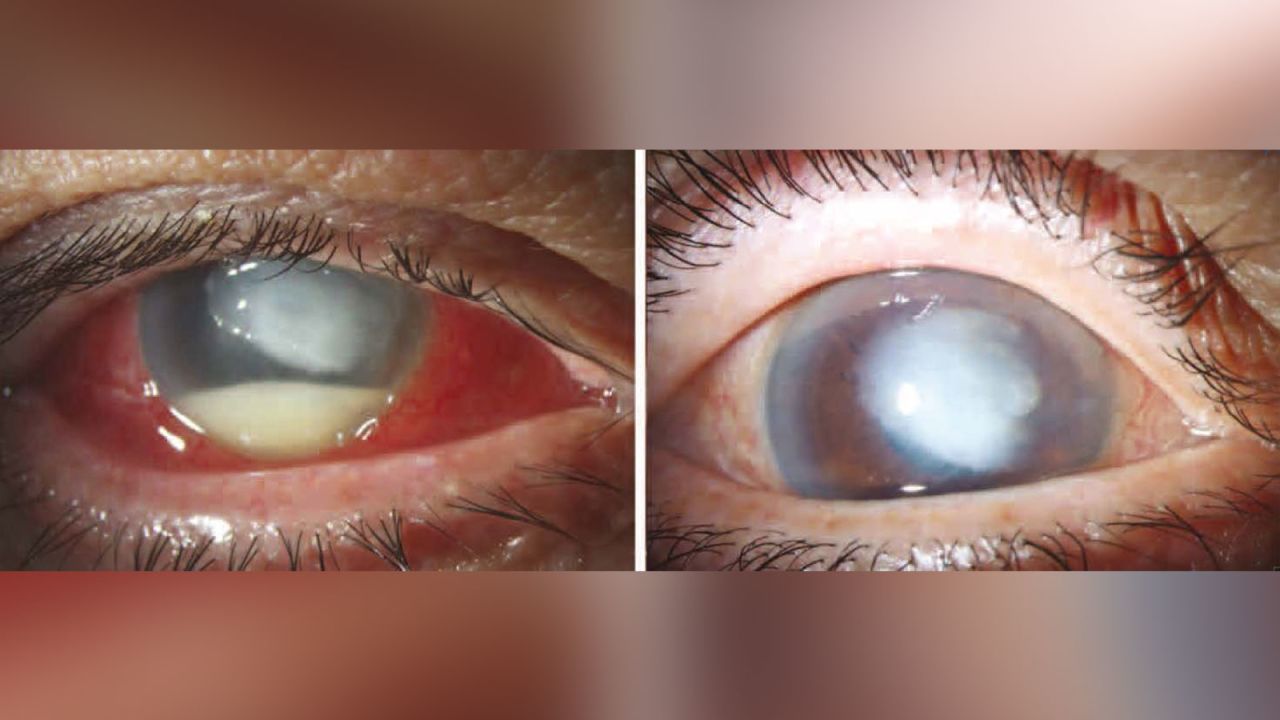 In another case, a 72-year-old man had a severe infection in his eye, left. Although it had improved a month later, right, he still experienced vision problems.