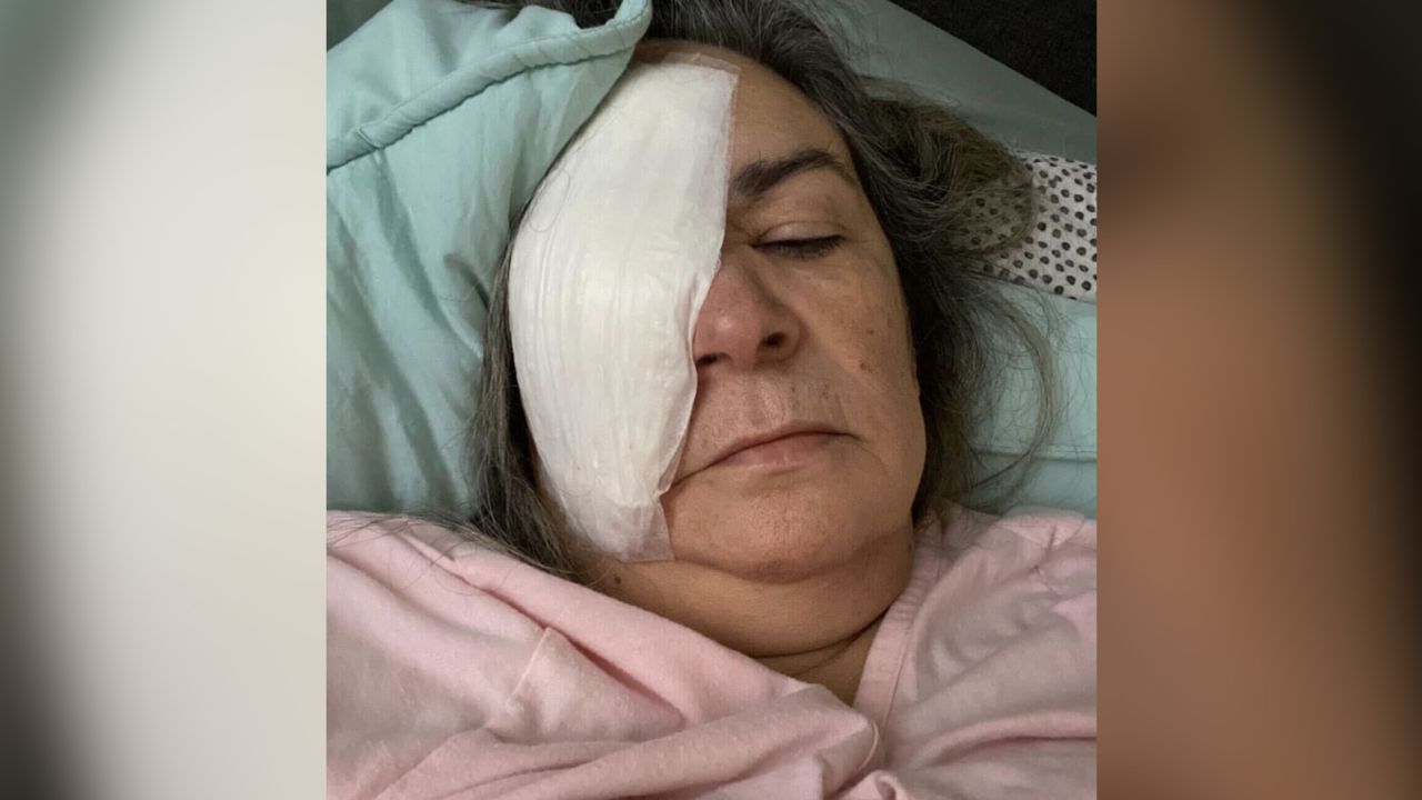 Clara Oliva had her right eye surgically removed after developing an ulcer on her eye.