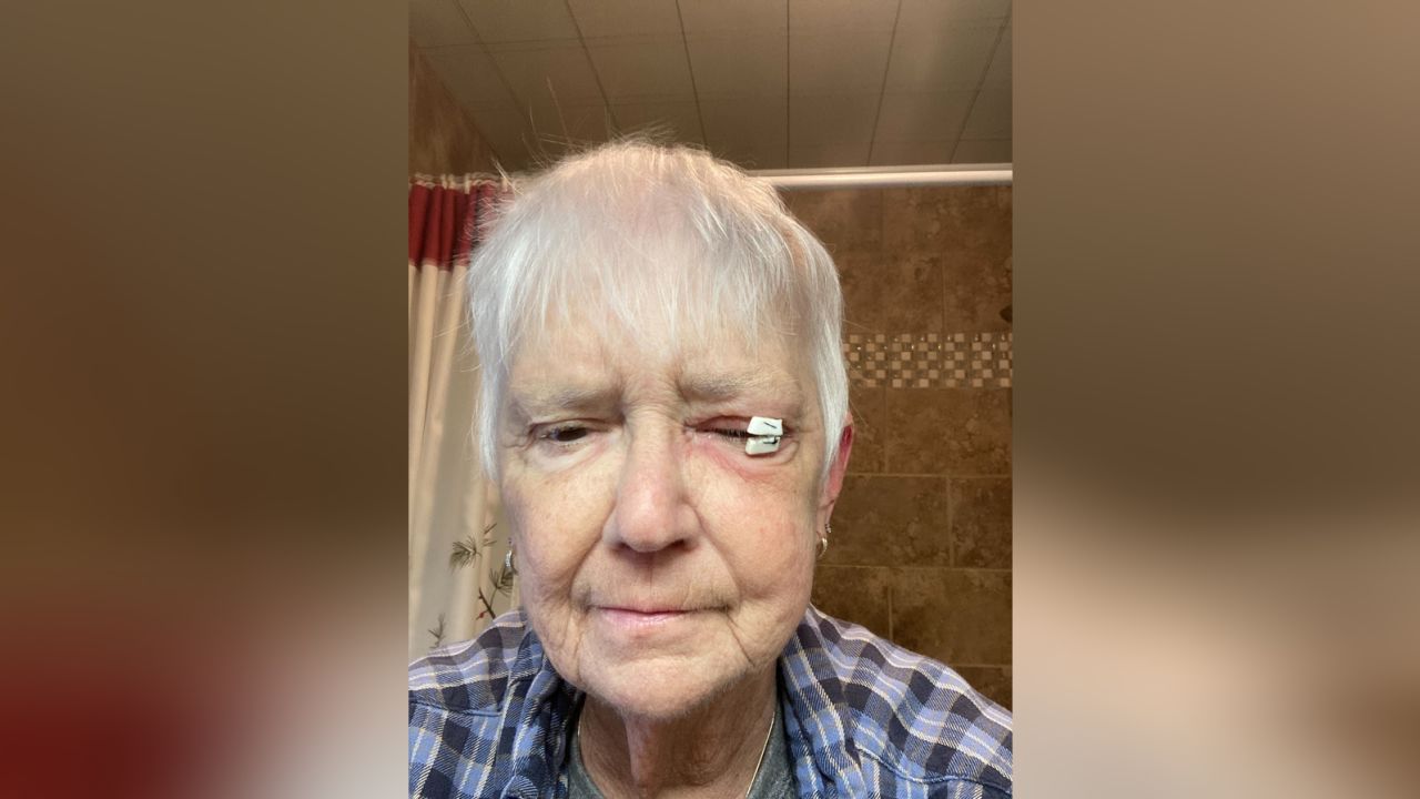 Nancy Montz menghabiskan tiga minggu di hospital dan kehilangan penglihatan di mata kirinya.