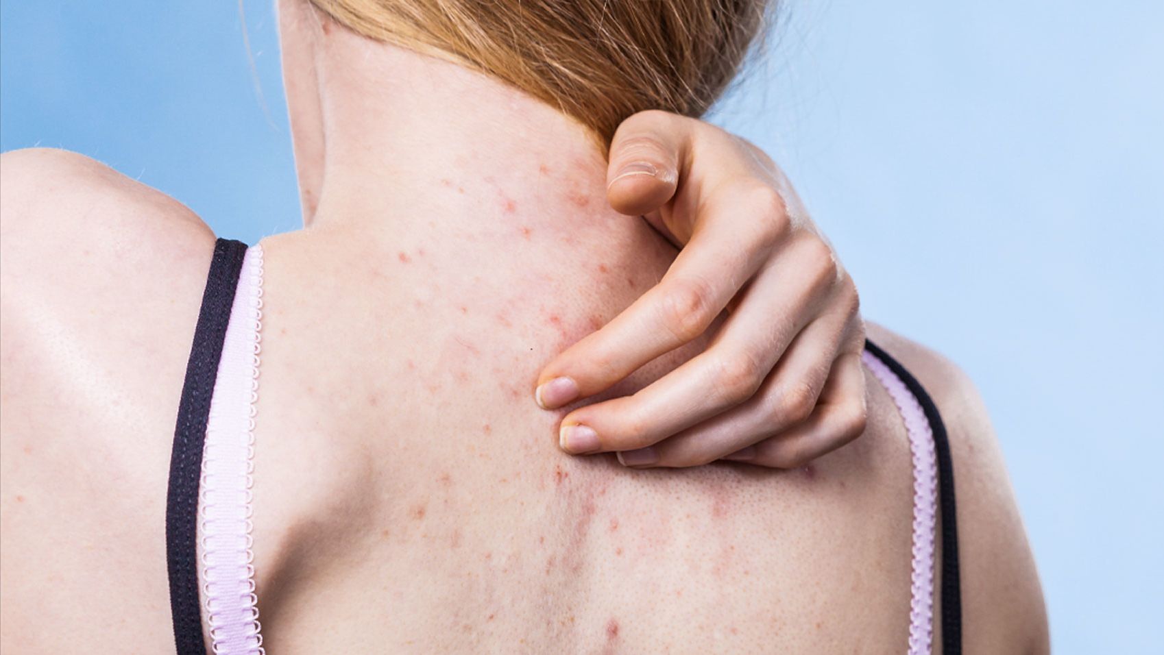 How to get rid of back acne: 15 treatments, washes and sprays for