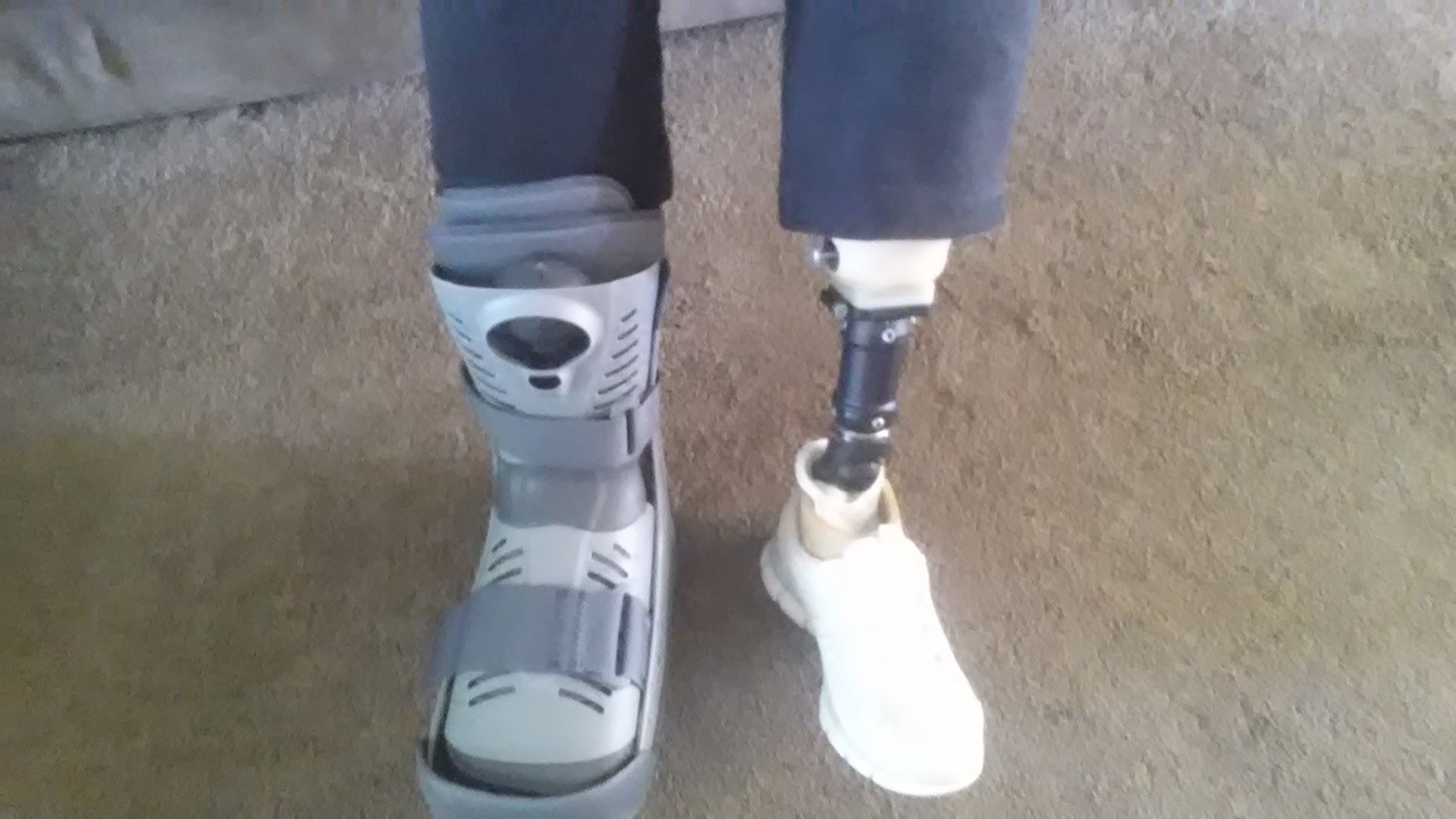 Woman says part of leg amputated after broken foot went undiagnosed for 2  months