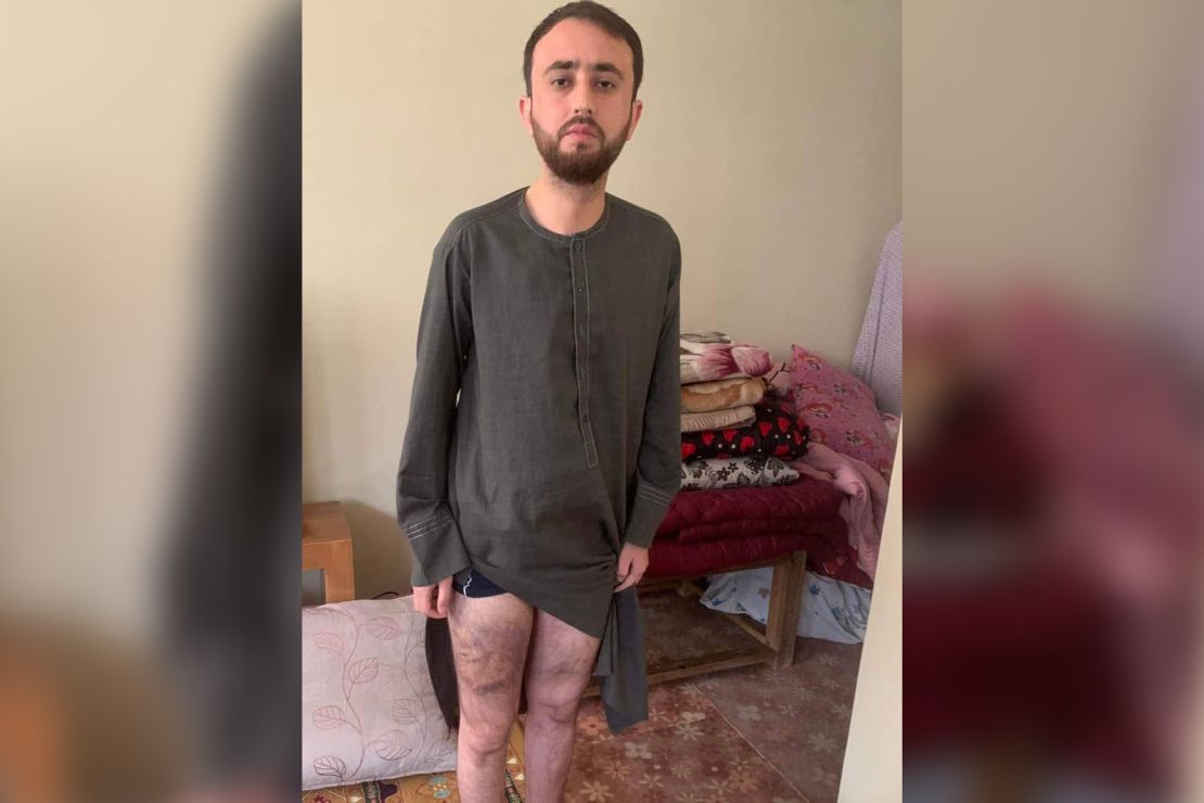 Zabihullah Noori, 27, shows bruises to his legs he says were inflicted by the Taliban.