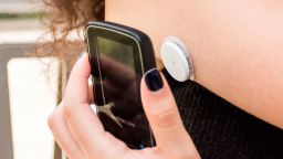 Diabetic teen equipped with glucose sensor and Freestyle Libre scanner which can just be flashed at the sensor on the back of arm to instantly measure blood sugar levels. (Photo by: BSIP/Universal Images Group via Getty Images)