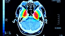 Brain showing Parkinsons disease 