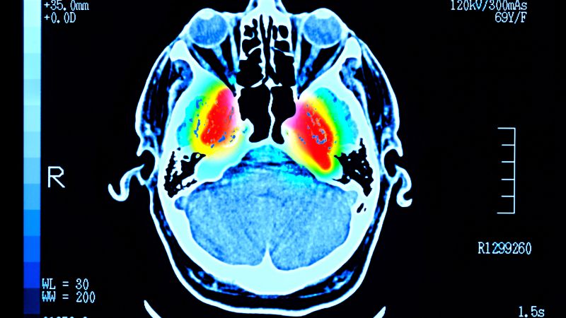 ‘Big Step Forward’: New Laboratory Test Could Accelerate Parkinson’s Disease Diagnosis and Research