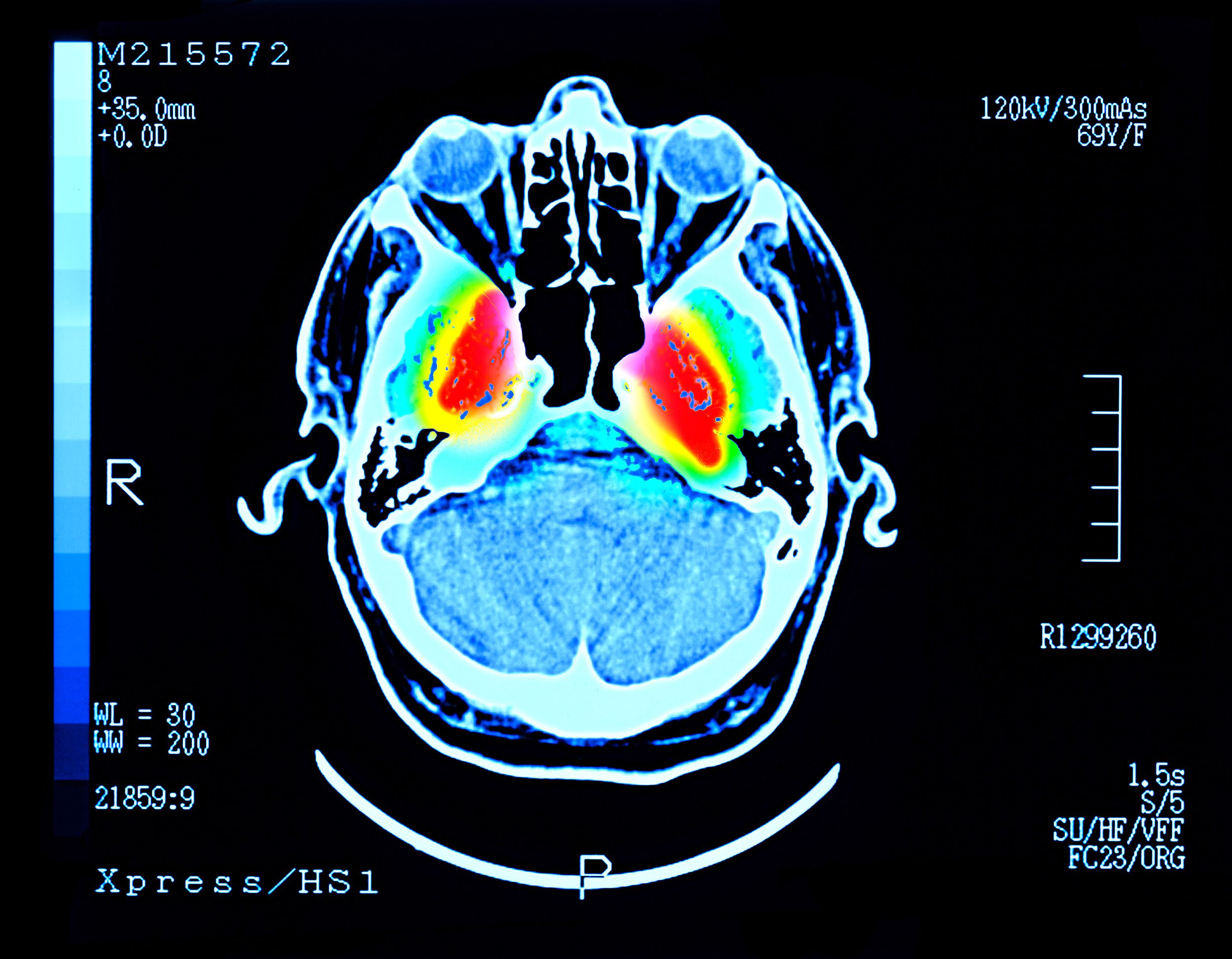 https://media.cnn.com/api/v1/images/stellar/prod/230413152857-brain-showing-parkinsons-disease.jpg?c=original