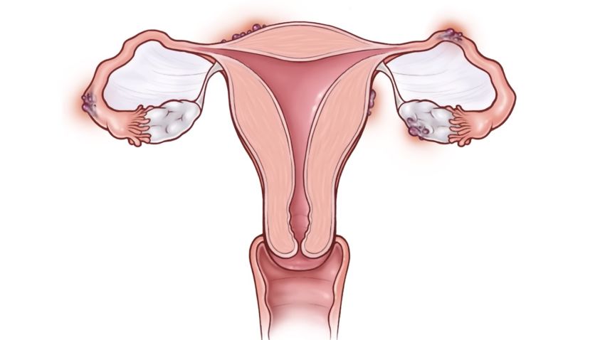 endometriosis uterus cleveland clinic