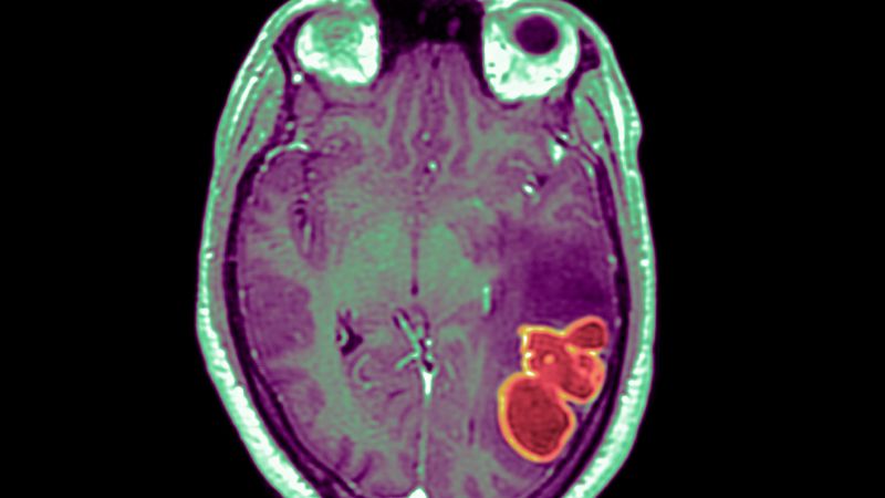 NextImg:Doctors watching for more cases after mysterious cluster of brain infections strikes kids in southern Nevada | CNN