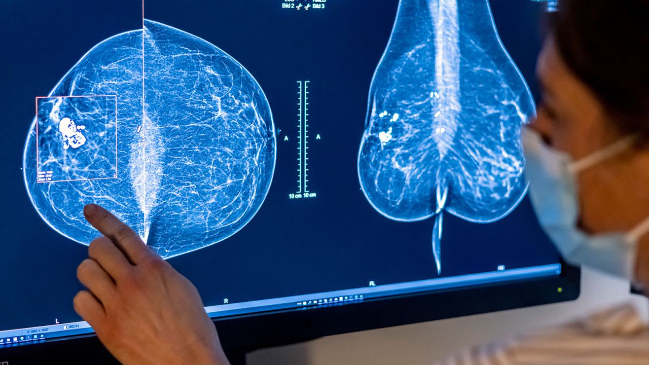  Medical personnel use a mammogram to examine a woman's breast for breast cancer.