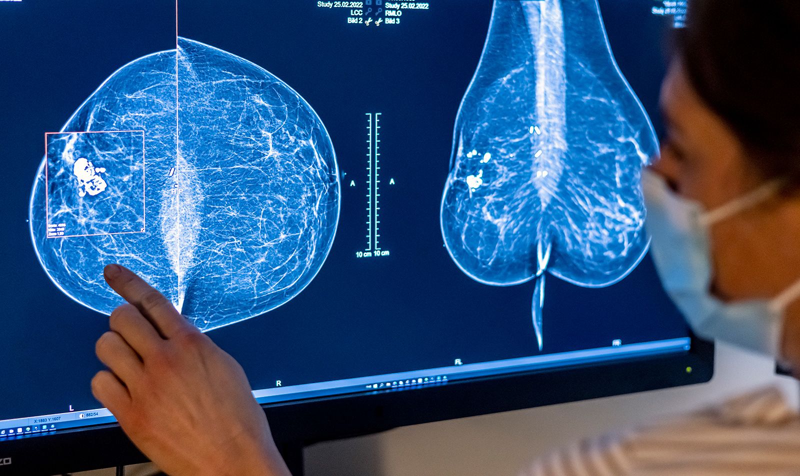Female breast cancer, illustration  Stock Image - Science Source Images