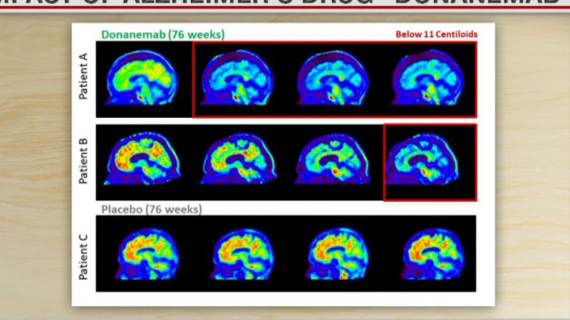 Clinical trial: Alzheimer’s drug slows down cognitive decline by 35% | CNN