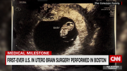 exp utero brain surgery gupta pkg 050402PSEG1 cnni world_00002001.png