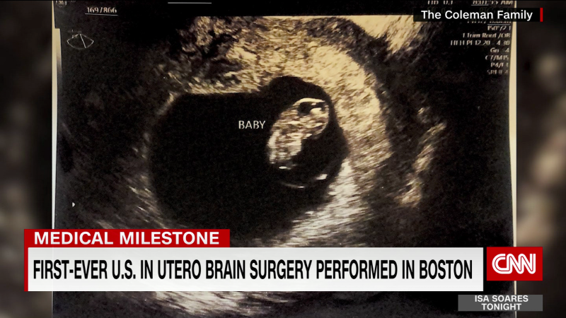 First-ever U.S. in utero brain surgery performed in Boston | CNN