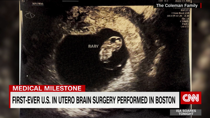 exp utero brain surgery gupta pkg 050402PSEG1 cnni world_00002001.png